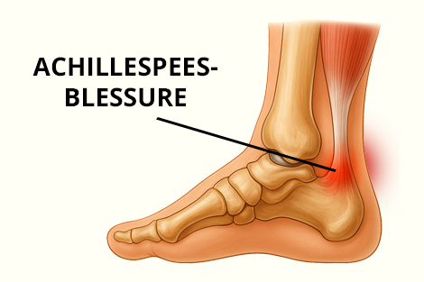 achillespeesblessure.jpg