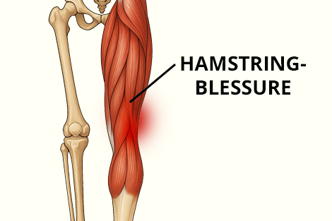 hamstringblessure.jpg