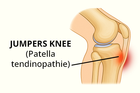 jumpers-knee-patella-tendinopathie.jpg