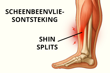 shin-splints-scheenbeenvliesontsteking.jpg